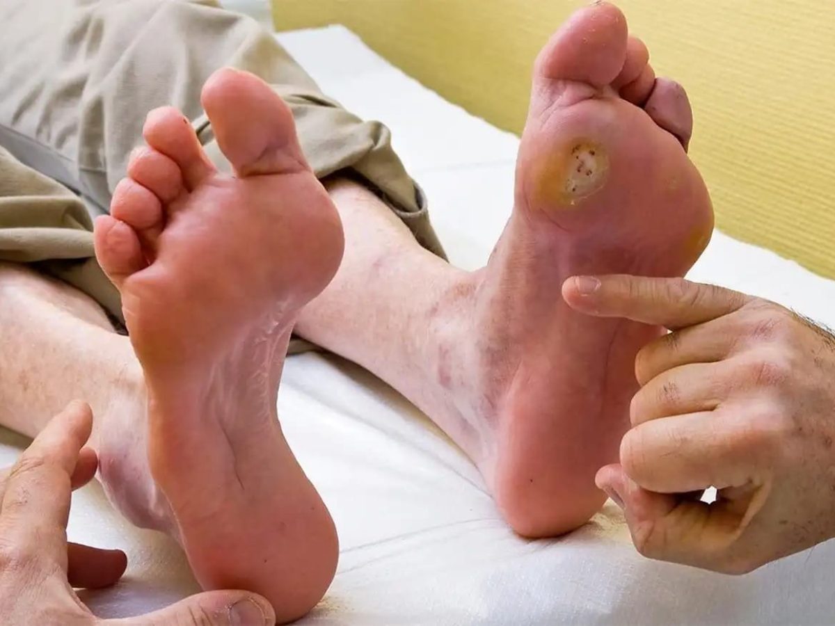 De Pés a Passos: A Importância do Cirurgião Vascular na Prevenção de Amputações em Diabéticos